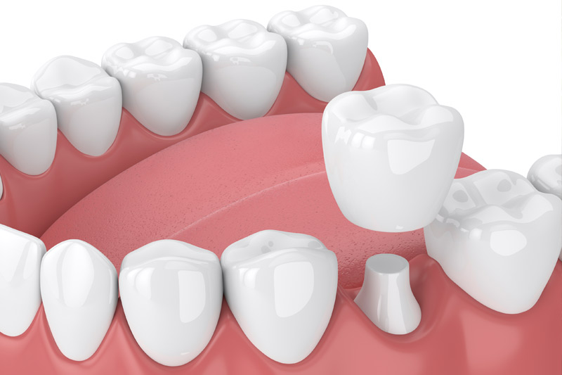 Dental Crowns in Plainfield