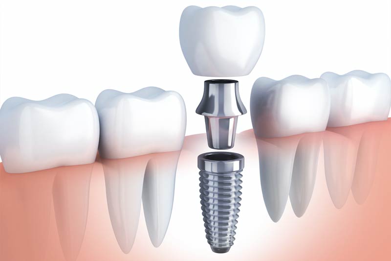 Implants Dentist in Plainfield