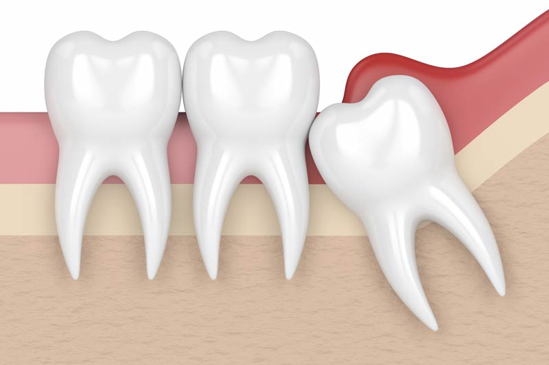 Wisdom Tooth Removal in Plainfield